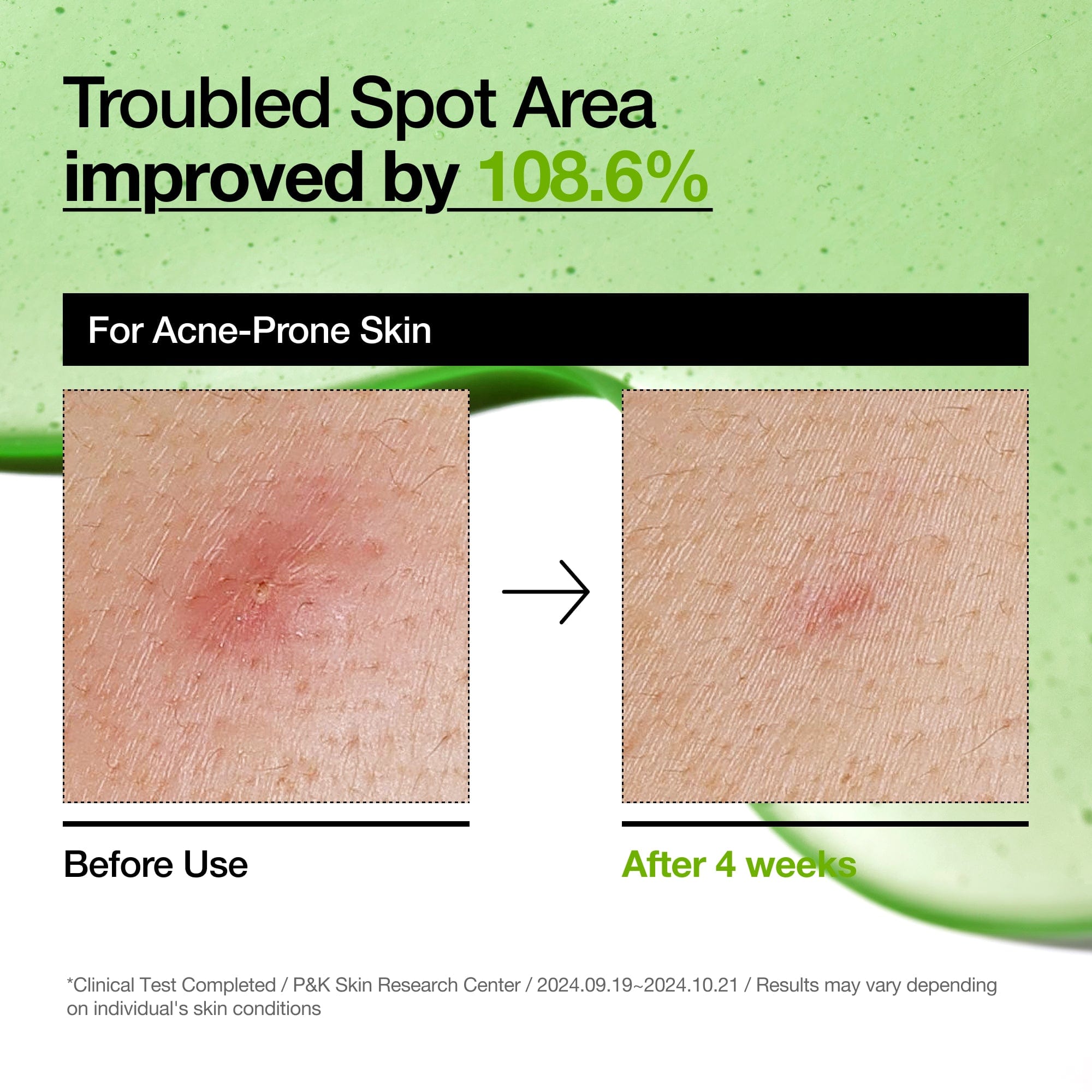 Anua - Azelaic Acid 10 Hyaluron Redness Soothing Serum