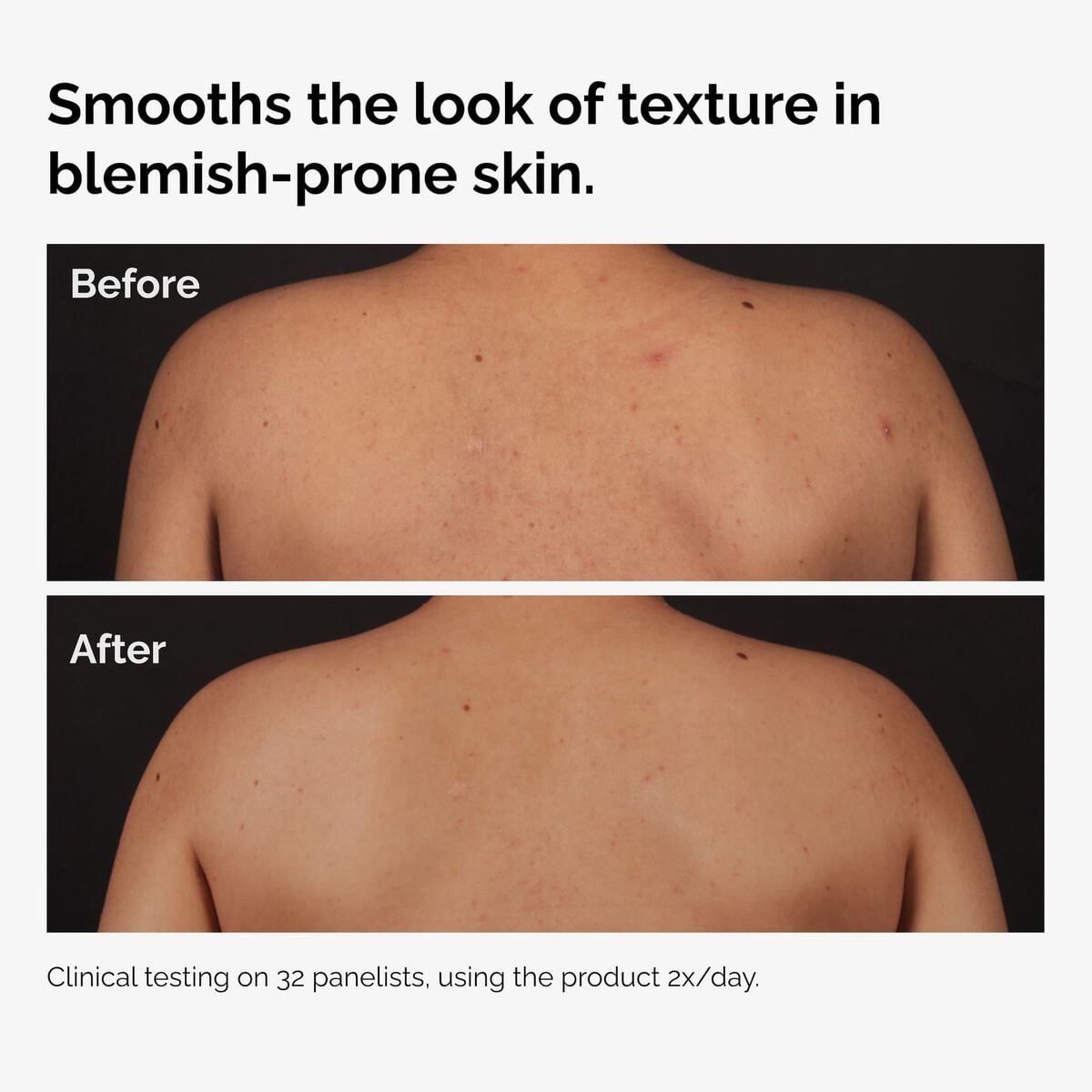 the ordinary - Salicylic Acid 0.5% Body Serum